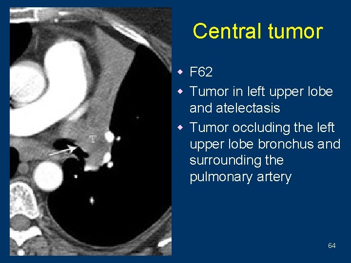 Central tumor w F 62 w Tumor in left upper lobe and atelectasis w