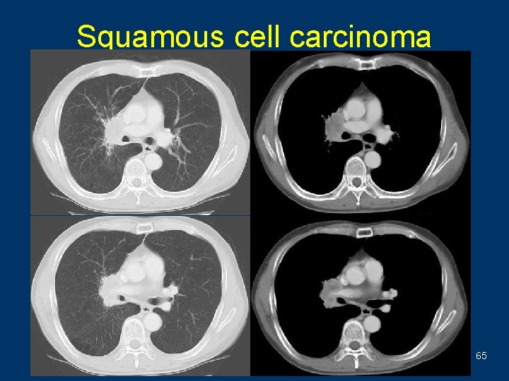 Squamous cell carcinoma 65 