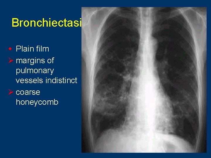 Bronchiectasis w Plain film Ø margins of pulmonary vessels indistinct Ø coarse honeycomb 7