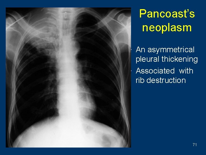 Pancoast’s neoplasm w An asymmetrical pleural thickening w Associated with rib destruction 71 