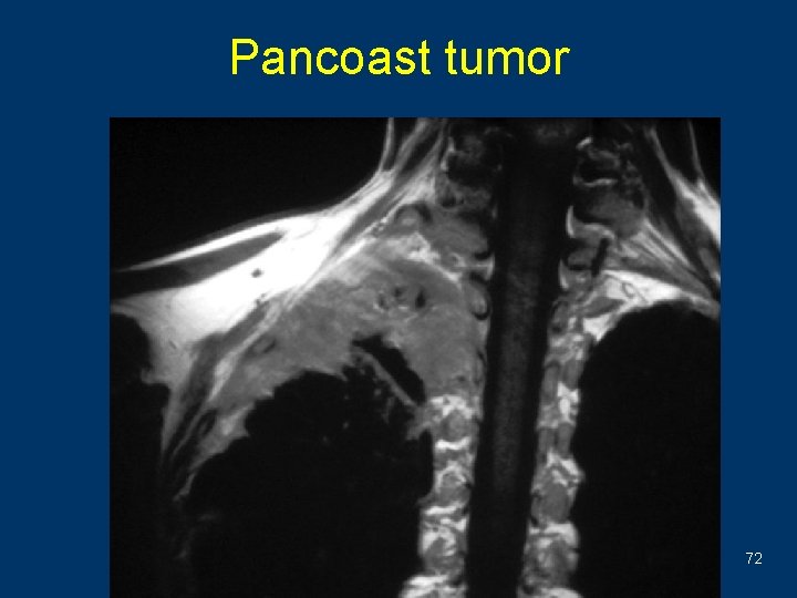 Pancoast tumor 72 