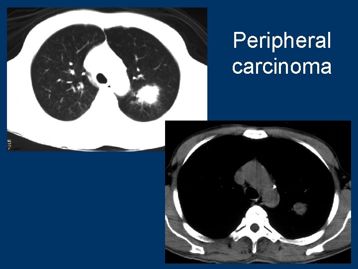 Peripheral carcinoma 74 