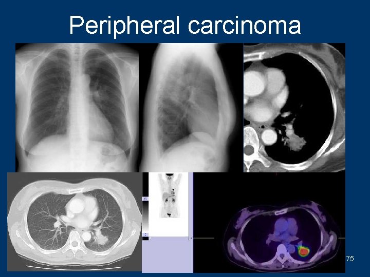 Peripheral carcinoma 75 