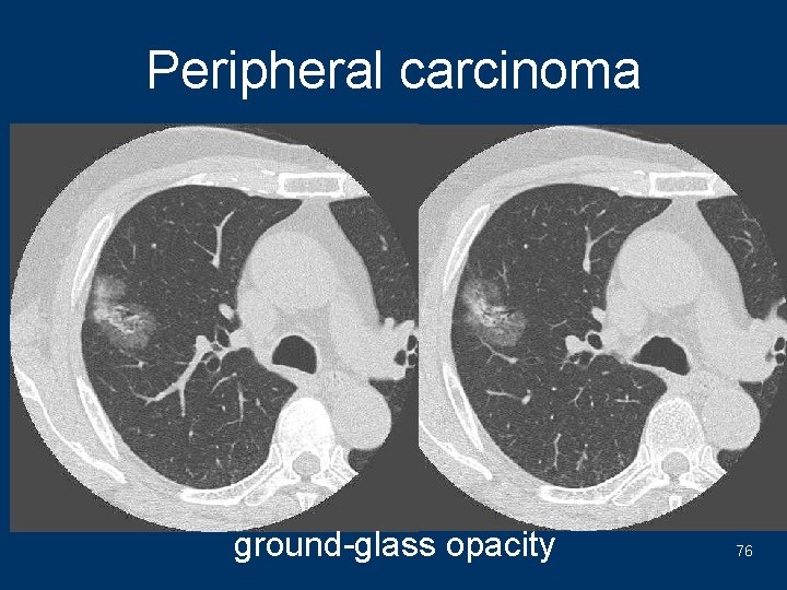 Peripheral carcinoma ground-glass opacity 76 