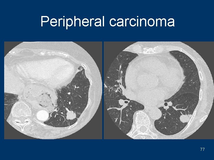 Peripheral carcinoma 77 