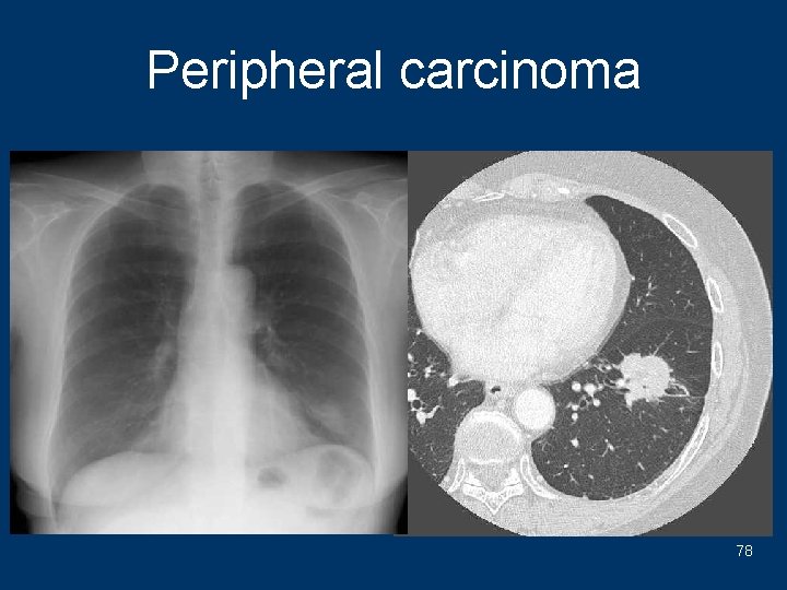 Peripheral carcinoma 78 