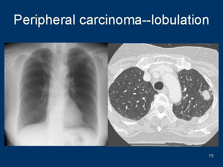 Peripheral carcinoma--lobulation 79 