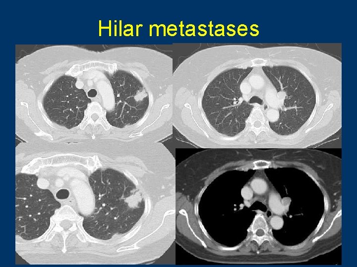 Hilar metastases 80 