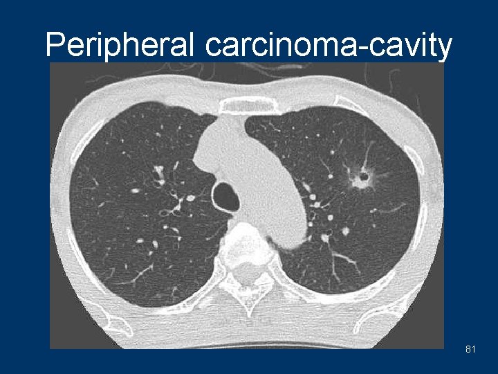 Peripheral carcinoma-cavity 81 