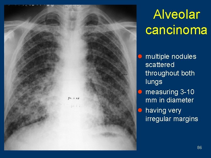 Alveolar cancinoma l multiple nodules scattered throughout both lungs l measuring 3 -10 mm