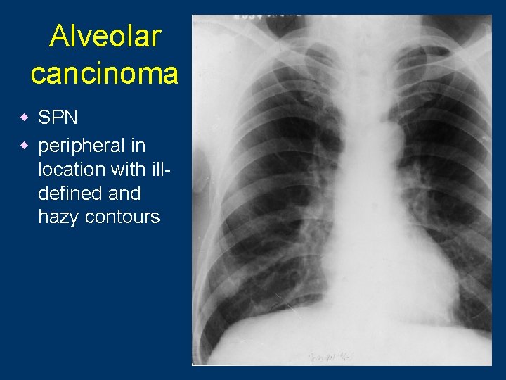 Alveolar cancinoma w SPN w peripheral in location with illdefined and hazy contours 87