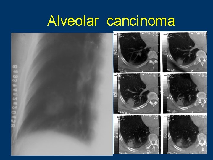 Alveolar cancinoma 88 