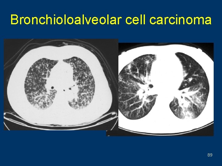 Bronchioloalveolar cell carcinoma 89 