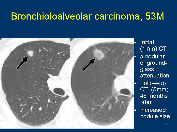 Bronchioloalveolar carcinoma, 53 M w Initial (1 mm) CT w a nodular of groundglass