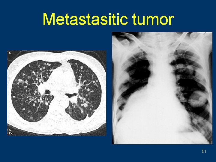Metastasitic tumor 91 
