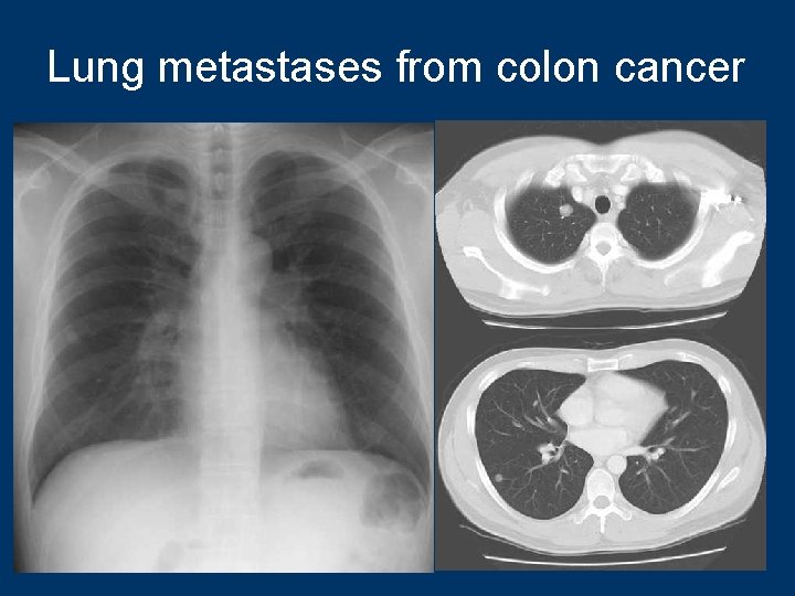 Lung metastases from colon cancer 92 