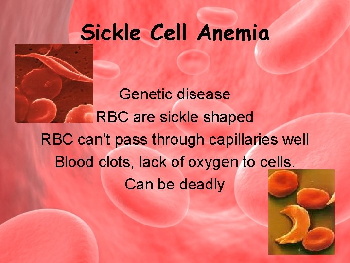 Sickle Cell Anemia Genetic disease RBC are sickle shaped RBC can’t pass through capillaries