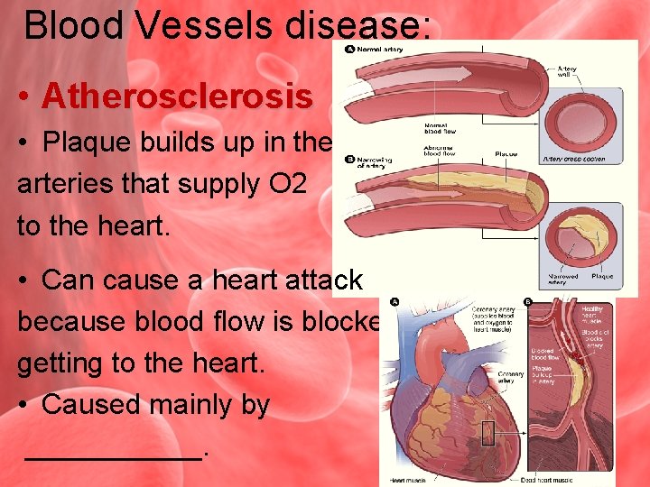 Blood Vessels disease: • Atherosclerosis • Plaque builds up in the arteries that supply