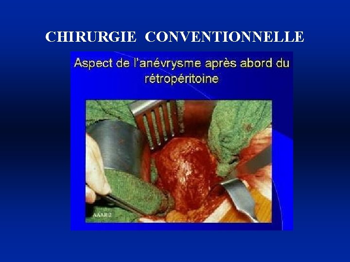 CHIRURGIE CONVENTIONNELLE 