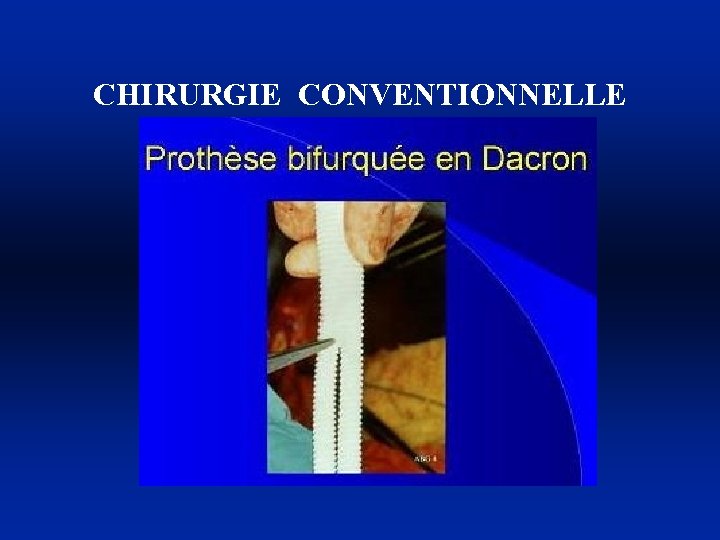 CHIRURGIE CONVENTIONNELLE 