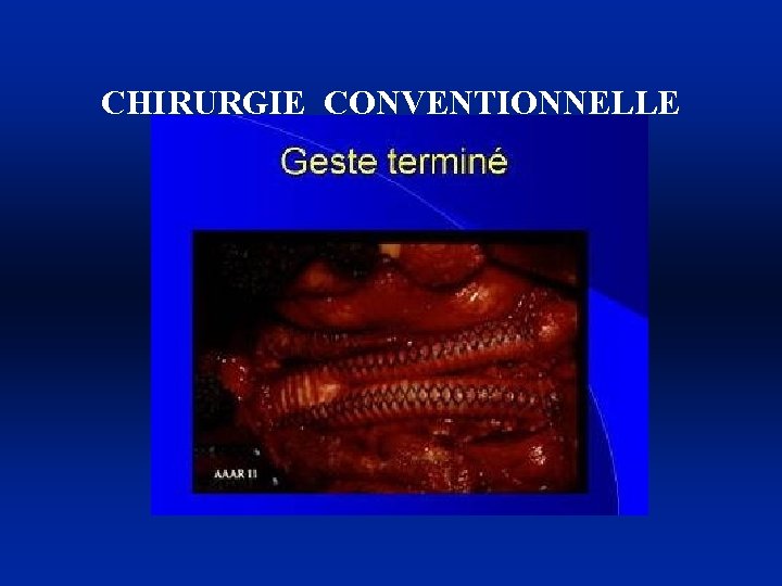 CHIRURGIE CONVENTIONNELLE 