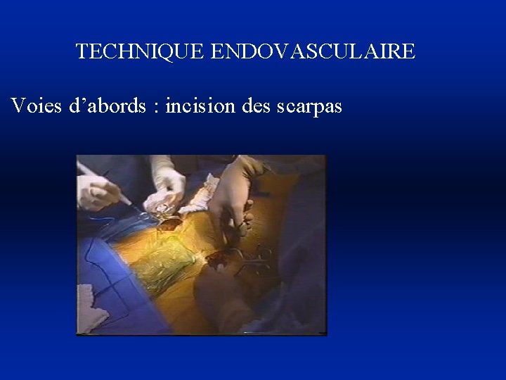 TECHNIQUE ENDOVASCULAIRE Voies d’abords : incision des scarpas 