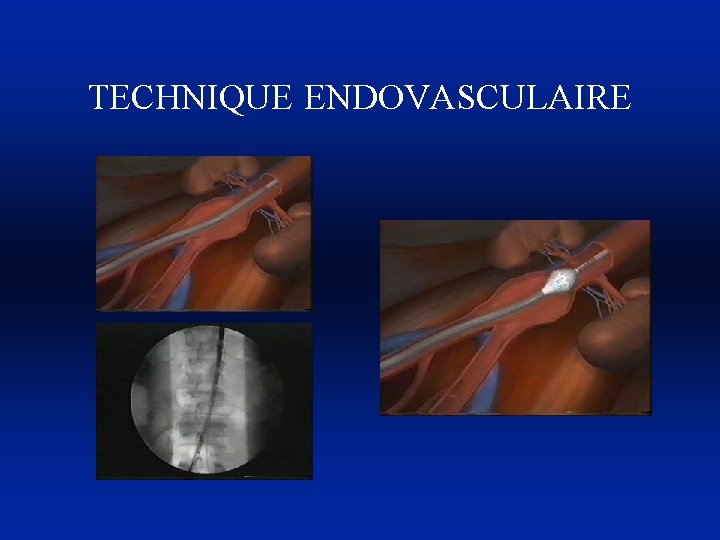 TECHNIQUE ENDOVASCULAIRE 