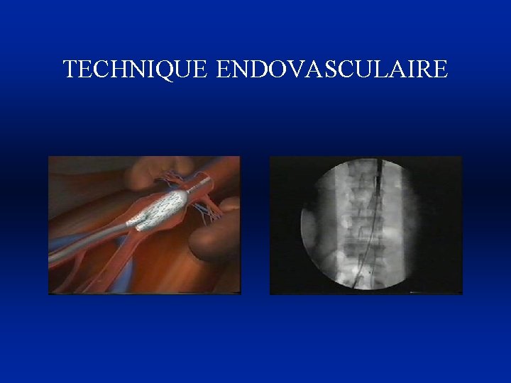 TECHNIQUE ENDOVASCULAIRE 