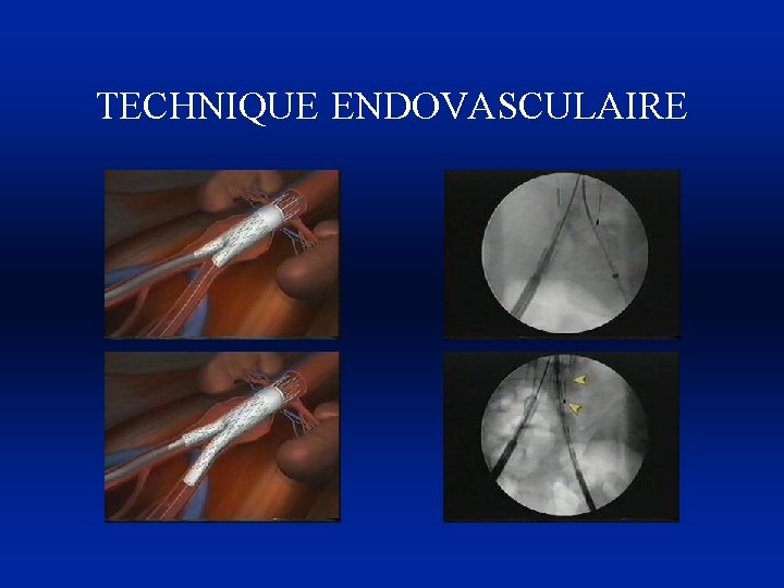 TECHNIQUE ENDOVASCULAIRE 