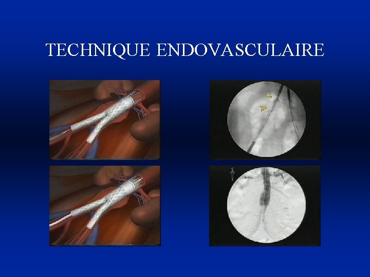 TECHNIQUE ENDOVASCULAIRE 