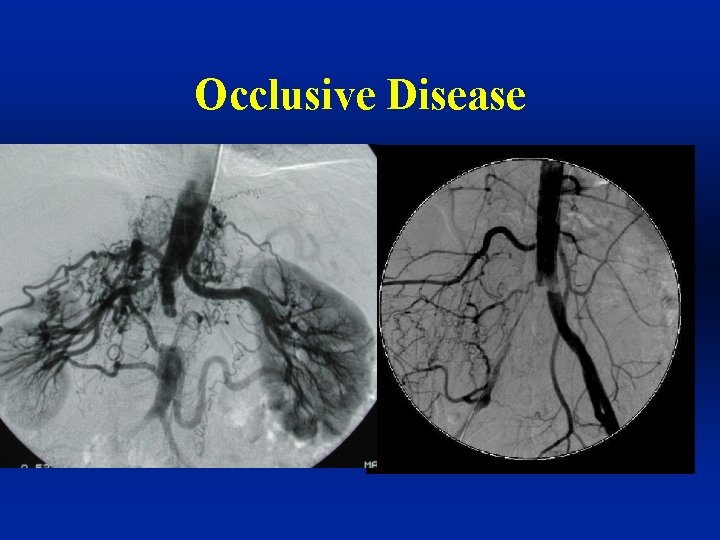 Occlusive Disease 