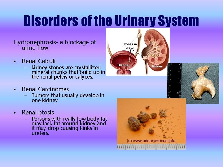 Disorders of the Urinary System Hydronephrosis- a blockage of urine flow • Renal Calculi