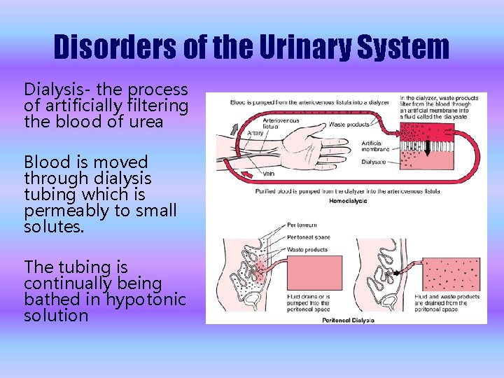 Disorders of the Urinary System Dialysis- the process of artificially filtering the blood of