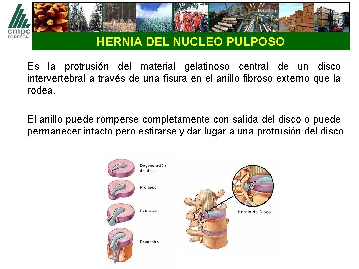 HERNIA DEL NUCLEO PULPOSO Es la protrusión del material gelatinoso central de un disco