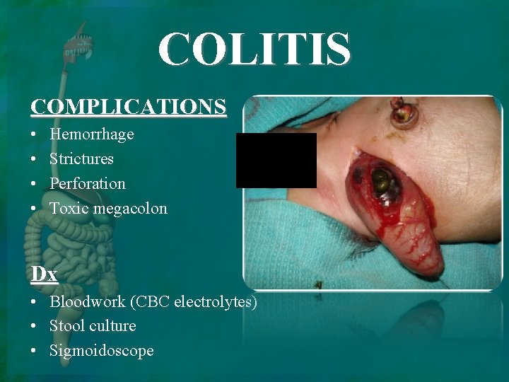 COLITIS COMPLICATIONS • • Hemorrhage Strictures Perforation Toxic megacolon Dx • Bloodwork (CBC electrolytes)