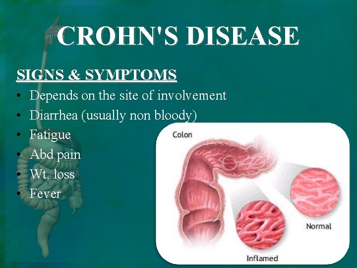 CROHN'S DISEASE SIGNS & SYMPTOMS • • • Depends on the site of involvement