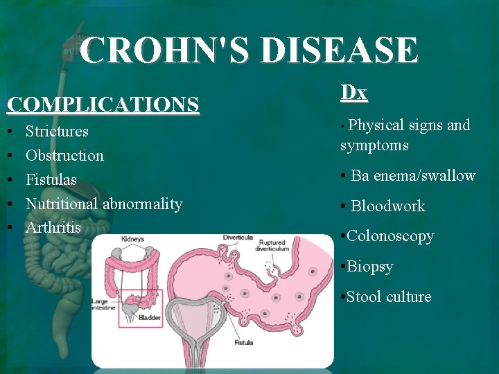 CROHN'S DISEASE COMPLICATIONS • • • Strictures Obstruction Fistulas Nutritional abnormality Arthritis Dx •