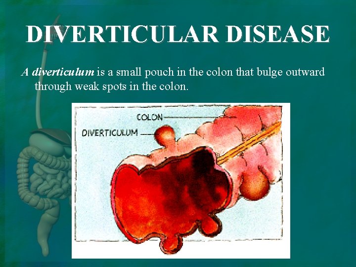 DIVERTICULAR DISEASE A diverticulum is a small pouch in the colon that bulge outward
