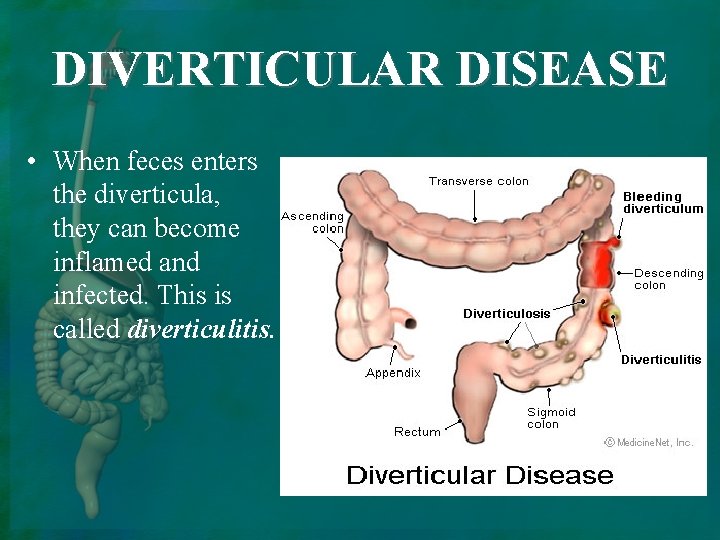 DIVERTICULAR DISEASE • When feces enters the diverticula, they can become inflamed and infected.