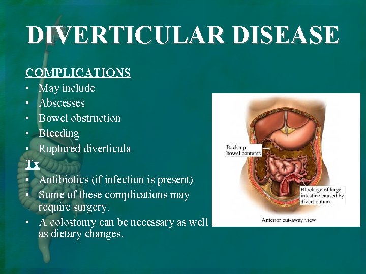 DIVERTICULAR DISEASE COMPLICATIONS • • • May include Abscesses Bowel obstruction Bleeding Ruptured diverticula