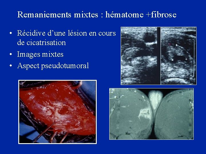 Remaniements mixtes : hématome +fibrose • Récidive d’une lésion en cours de cicatrisation •