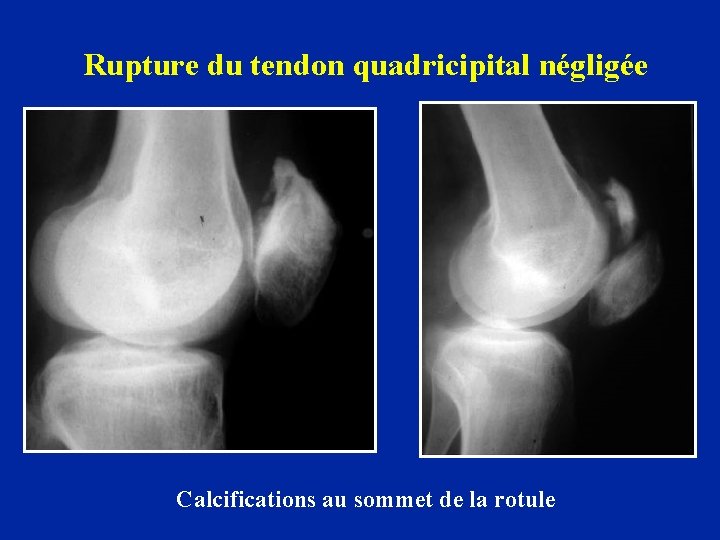 Rupture du tendon quadricipital négligée Calcifications au sommet de la rotule 