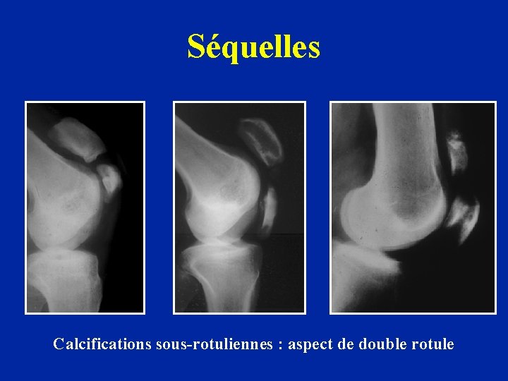 Séquelles Calcifications sous-rotuliennes : aspect de double rotule 