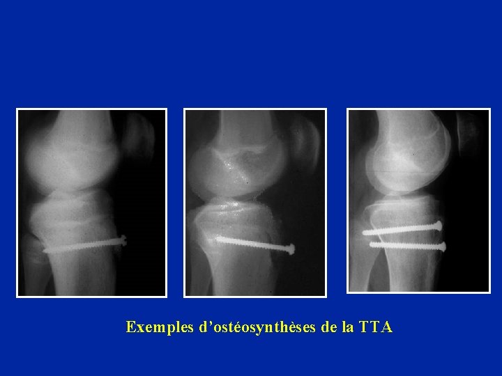 Exemples d’ostéosynthèses de la TTA 