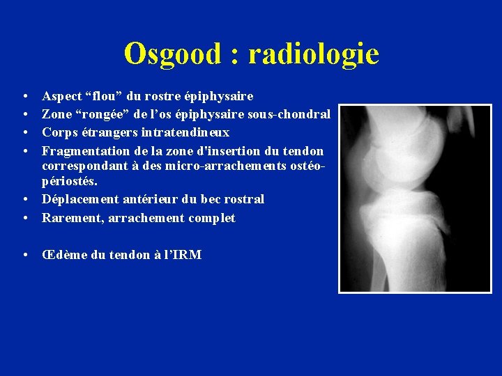 Osgood : radiologie • • Aspect “flou” du rostre épiphysaire Zone “rongée” de l’os