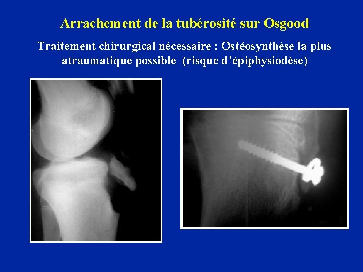 Arrachement de la tubérosité sur Osgood Traitement chirurgical nécessaire : Ostéosynthèse la plus atraumatique