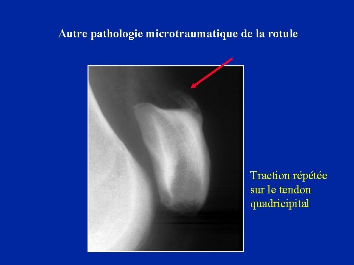 Autre pathologie microtraumatique de la rotule Traction répétée sur le tendon quadricipital 