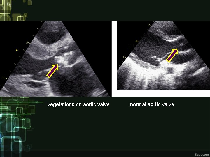 vegetations on aortic valve normal aortic valve 