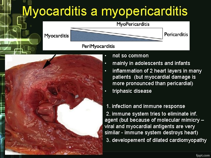 Myocarditis a myopericarditis • • not so common mainly in adolescents and infants inflammation