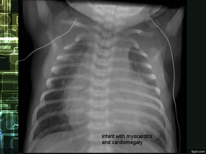 infant with myocarditis and cardiomegaly 